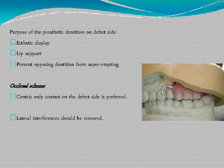 Purpose of the prosthetic dentition on defect side: �Esthetic display �Lip support �Prevent opposing