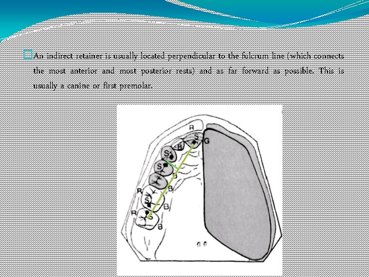 �An indirect retainer is usually located perpendicular to the fulcrum line (which connects the