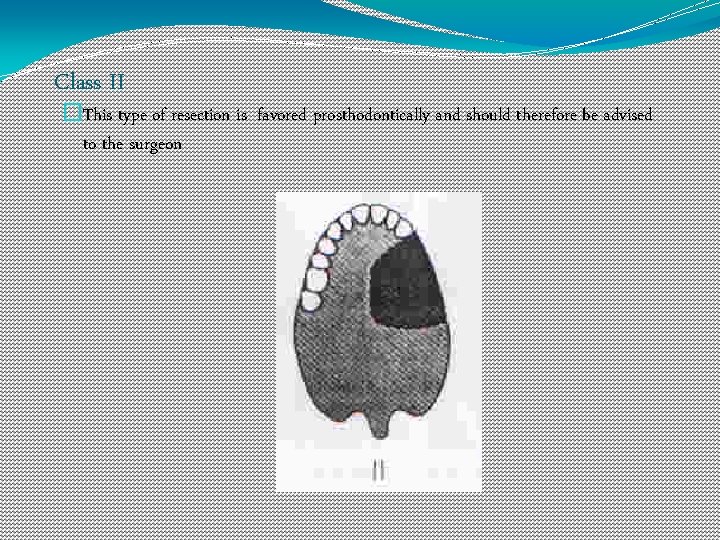 Class II �This type of resection is favored prosthodontically and should therefore be advised