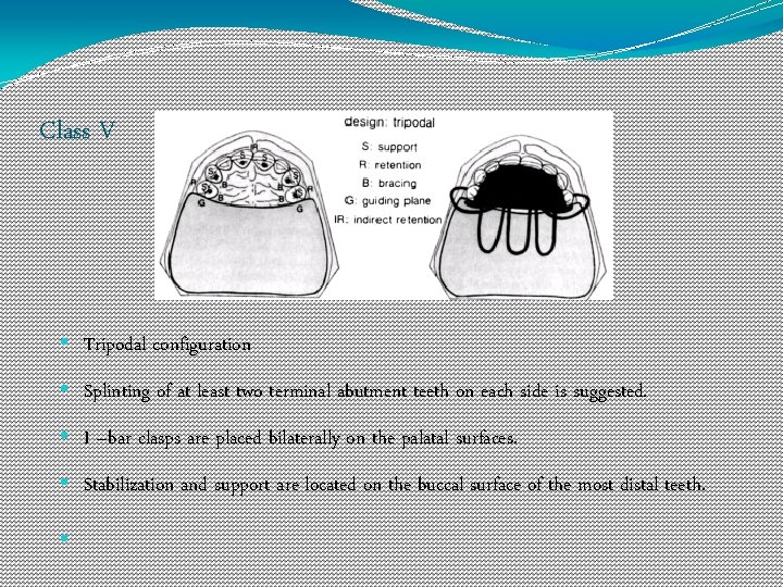 Class V • Tripodal configuration • Splinting of at least two terminal abutment teeth