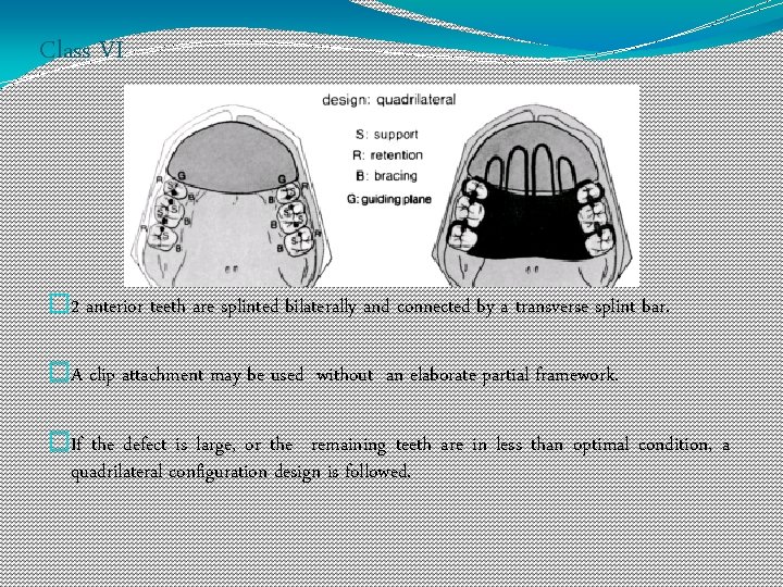 Class VI � 2 anterior teeth are splinted bilaterally and connected by a transverse