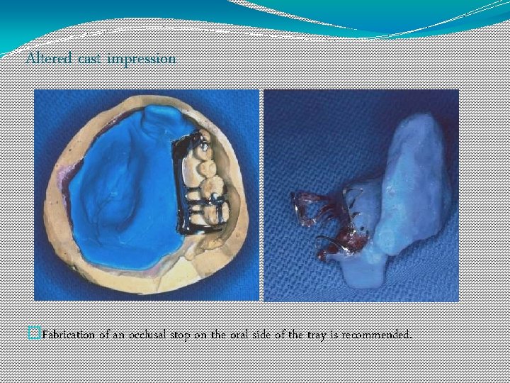 Altered cast impression �Fabrication of an occlusal stop on the oral side of the