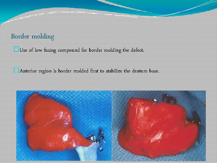 Border molding �Use of low fusing compound for border molding the defect. �Anterior region