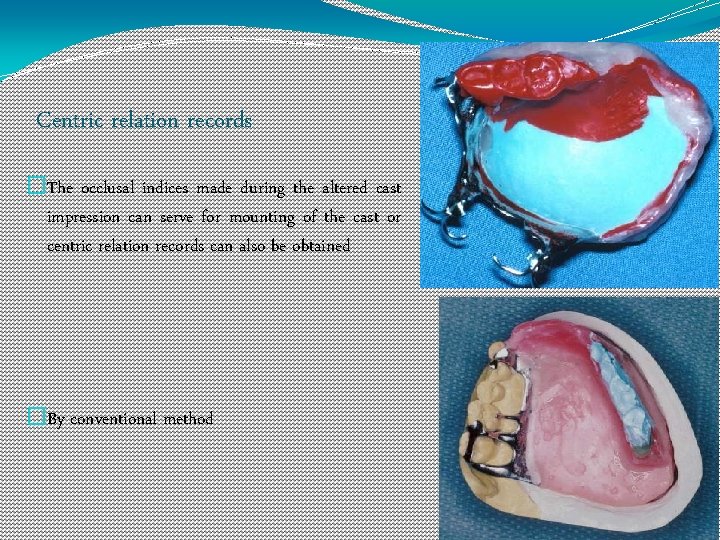 Centric relation records �The occlusal indices made during the altered cast impression can serve