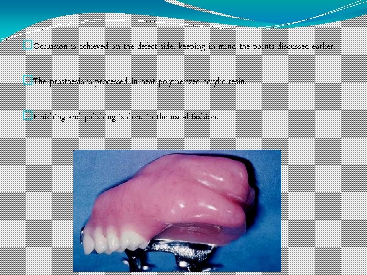 �Occlusion is achieved on the defect side, keeping in mind the points discussed earlier.