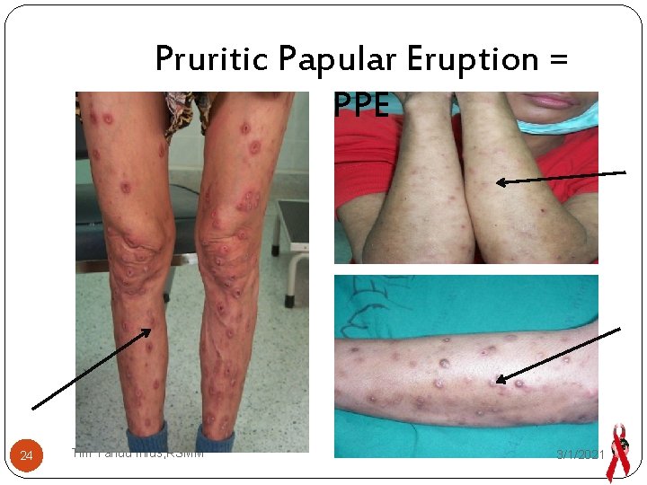 Pruritic Papular Eruption = PPE 24 Tim Yandu Infus, RSMM 3/1/2021 