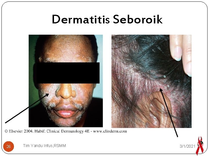 Dermatitis Seboroik 26 Tim Yandu Infus, RSMM 3/1/2021 