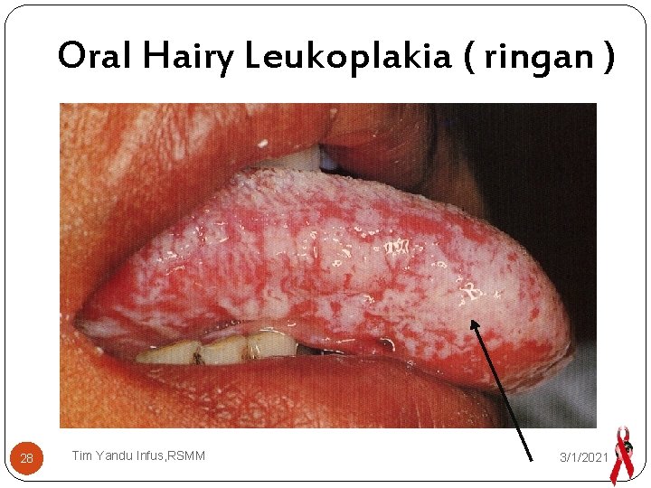 Oral Hairy Leukoplakia ( ringan ) 28 Tim Yandu Infus, RSMM 3/1/2021 