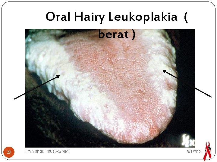 Oral Hairy Leukoplakia ( berat ) 29 Tim Yandu Infus, RSMM 3/1/2021 