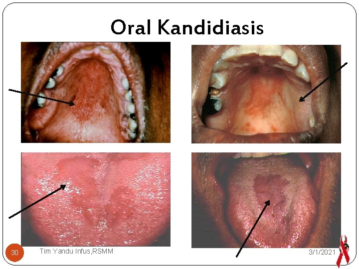 Oral Kandidiasis 30 Tim Yandu Infus, RSMM 3/1/2021 