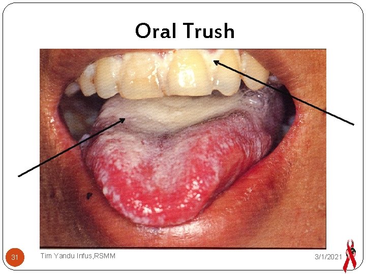 Oral Trush 31 Tim Yandu Infus, RSMM 3/1/2021 