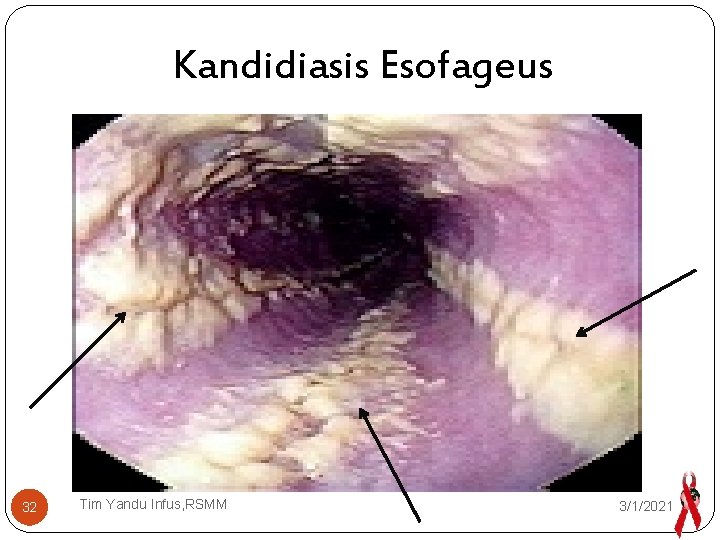 Kandidiasis Esofageus 32 Tim Yandu Infus, RSMM 3/1/2021 