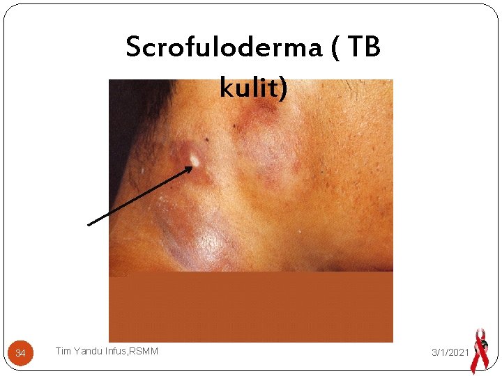 Scrofuloderma ( TB kulit) 34 Tim Yandu Infus, RSMM 3/1/2021 