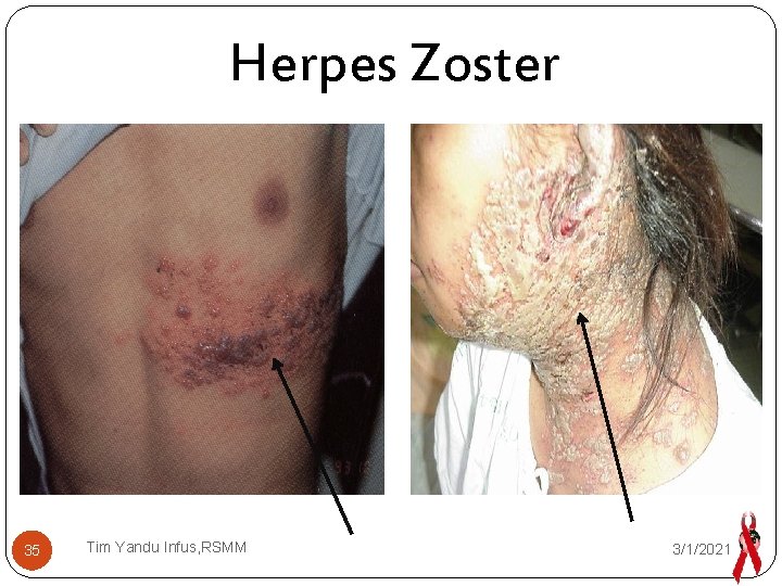 Herpes Zoster 35 Tim Yandu Infus, RSMM 3/1/2021 