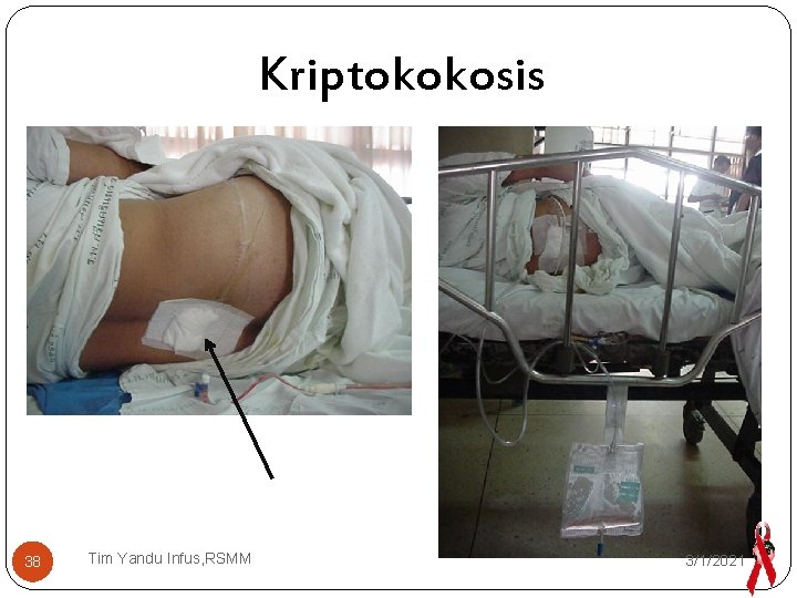 Kriptokokosis 38 Tim Yandu Infus, RSMM 3/1/2021 