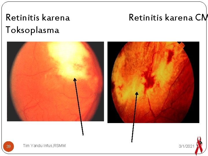 Retinitis karena Toksoplasma 39 Tim Yandu Infus, RSMM Retinitis karena CM 3/1/2021 