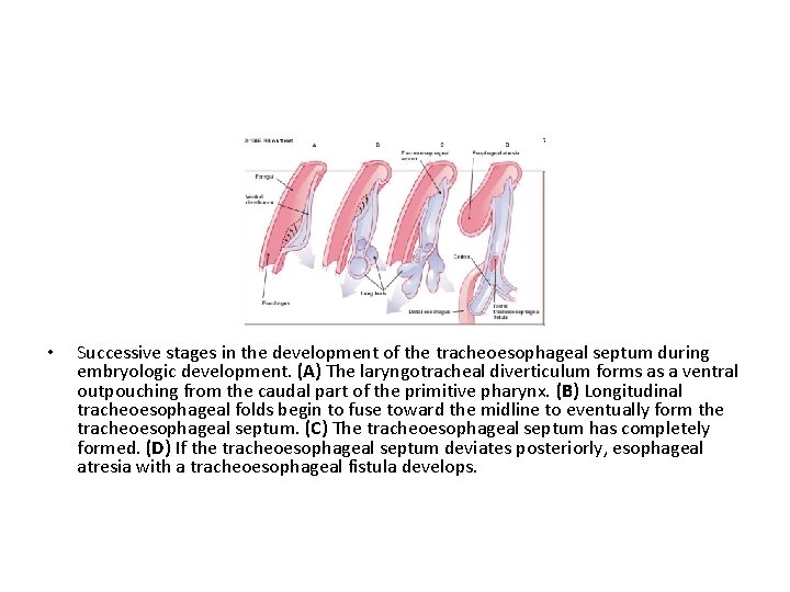  • Successive stages in the development of the tracheoesophageal septum during embryologic development.