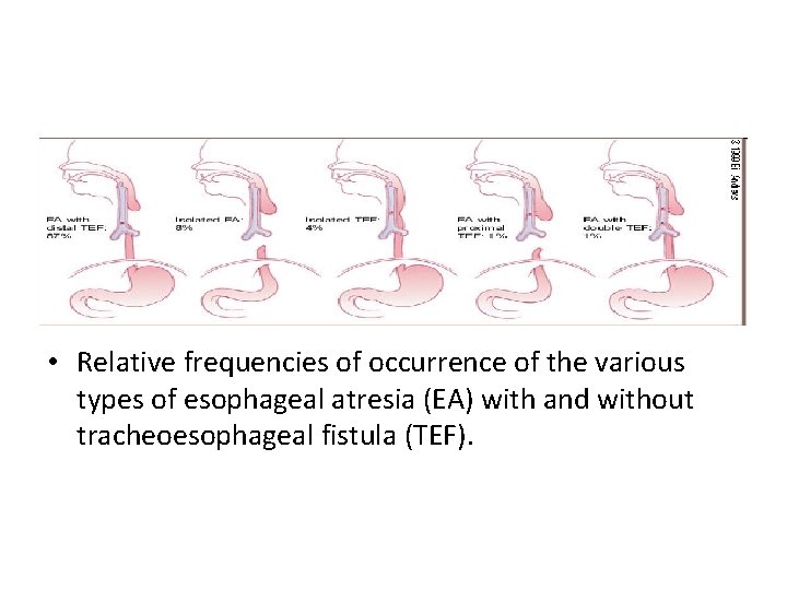  • Relative frequencies of occurrence of the various types of esophageal atresia (EA)