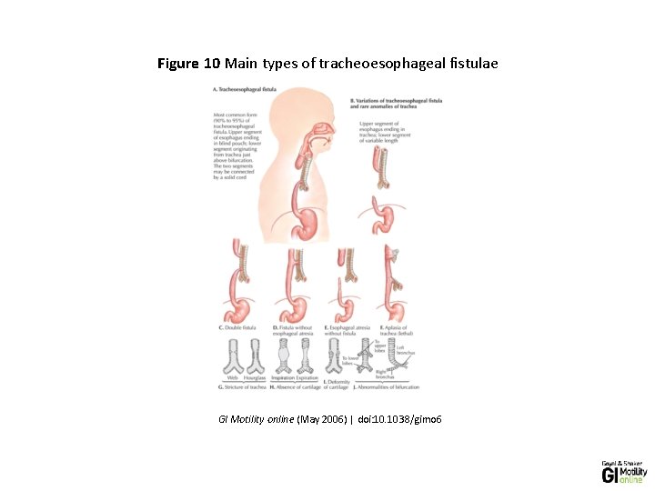 Figure 10 Main types of tracheoesophageal fistulae GI Motility online (May 2006) | doi: