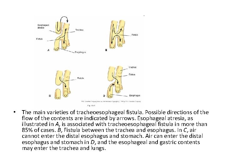  • The main varieties of tracheoesophageal fistula. Possible directions of the flow of