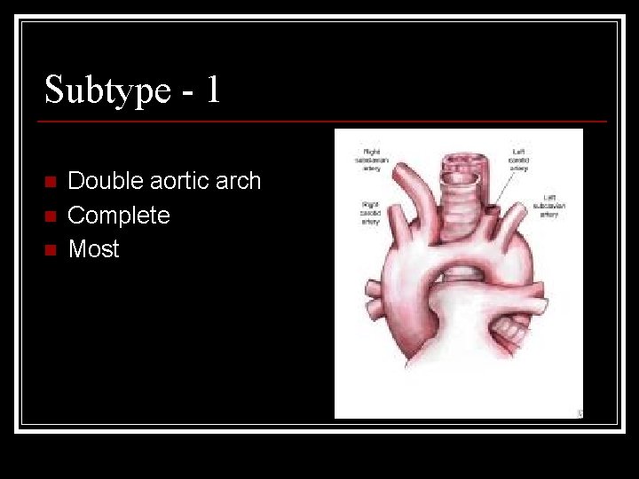 Subtype - 1 n n n Double aortic arch Complete Most 