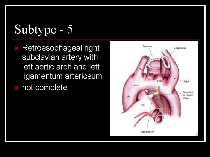 Subtype - 5 n n Retroesophageal right subclavian artery with left aortic arch and