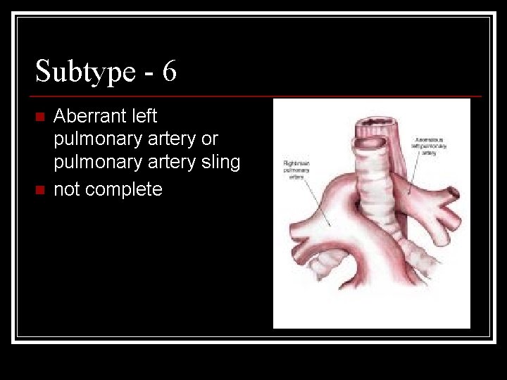 Subtype - 6 n n Aberrant left pulmonary artery or pulmonary artery sling not