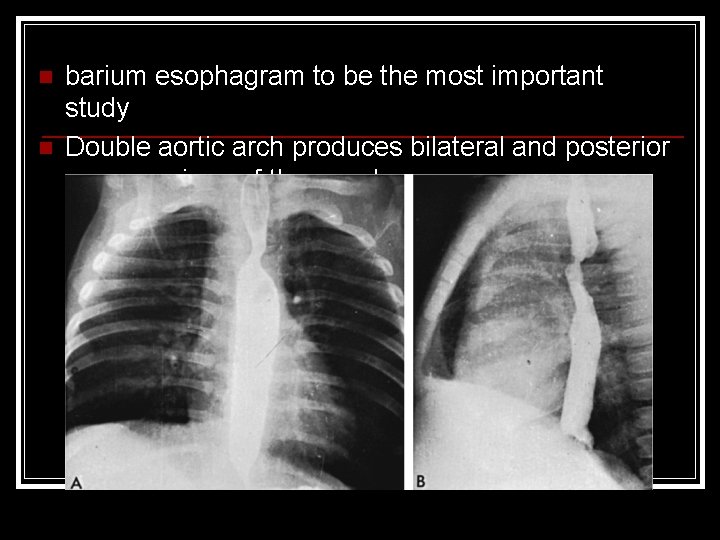 n n barium esophagram to be the most important study Double aortic arch produces