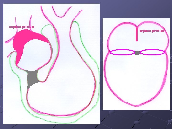 septum primum 