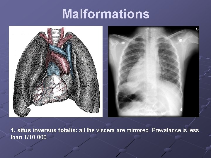 Malformations 1. situs inversus totalis: all the viscera are mirrored. Prevalance is less than
