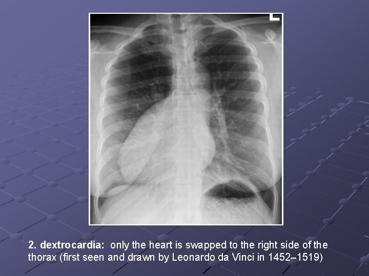 2. dextrocardia: only the heart is swapped to the right side of the thorax
