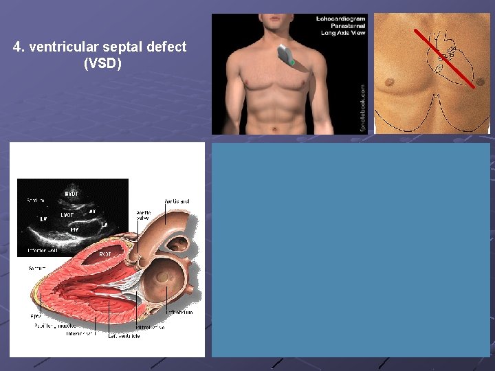 4. ventricular septal defect (VSD) 