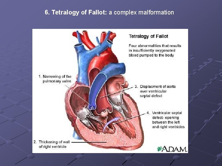 6. Tetralogy of Fallot: a complex malformation 