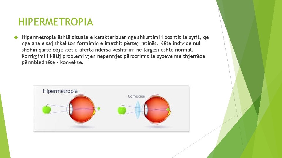 HIPERMETROPIA Hipermetropia është situata e karakterizuar nga shkurtimi i boshtit te syrit, qe nga