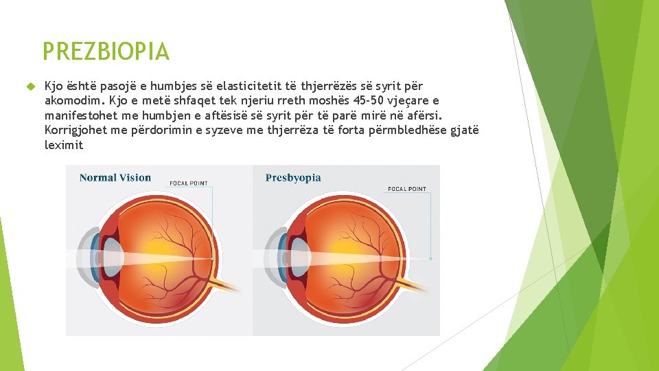 PREZBIOPIA Kjo është pasojë e humbjes së elasticitetit të thjerrëzës së syrit për akomodim.