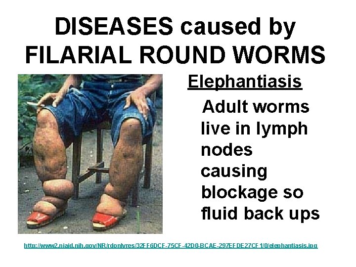 DISEASES caused by FILARIAL ROUND WORMS Elephantiasis Adult worms live in lymph nodes causing