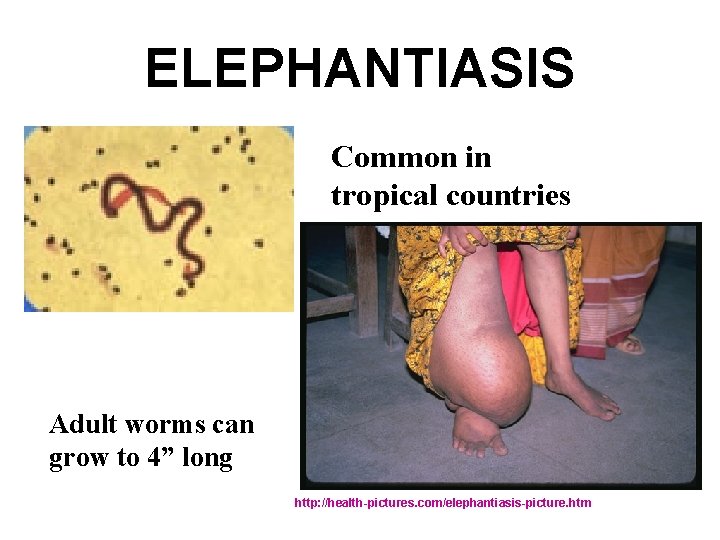 ELEPHANTIASIS Common in tropical countries Adult worms can grow to 4” long http: //health-pictures.