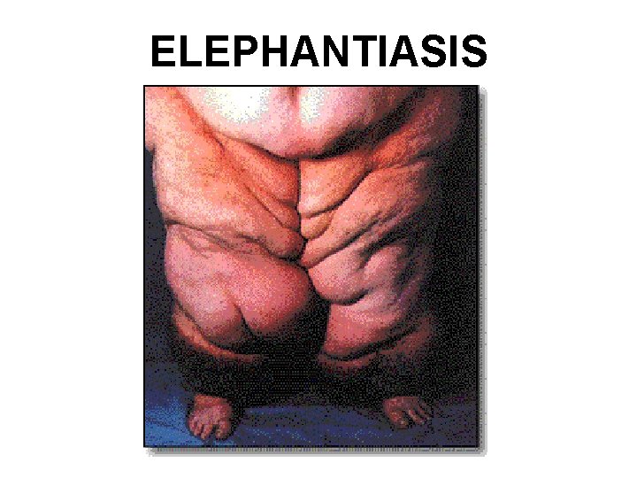 ELEPHANTIASIS 