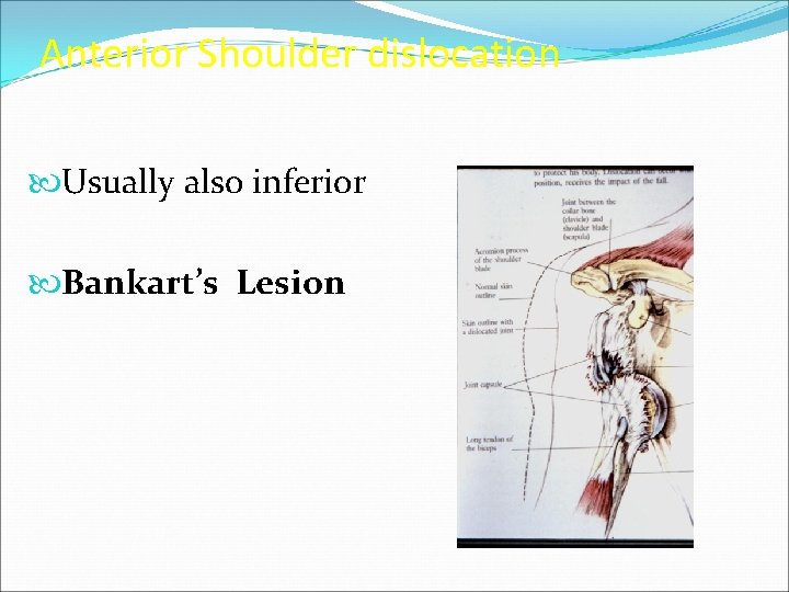 Anterior Shoulder dislocation Usually also inferior Bankart’s Lesion 