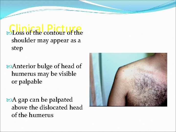 Clinical Picture Loss of the contour of the shoulder may appear as a step