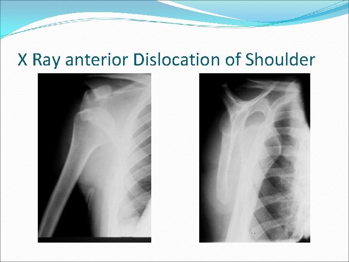 X Ray anterior Dislocation of Shoulder 