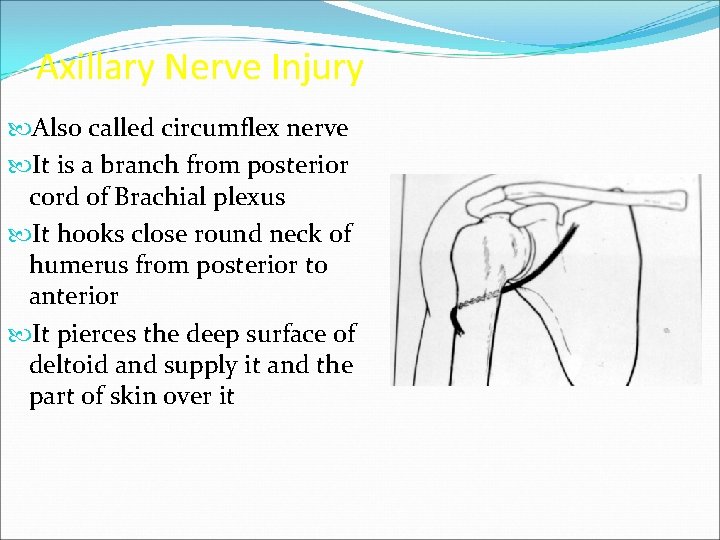 Axillary Nerve Injury Also called circumflex nerve It is a branch from posterior cord