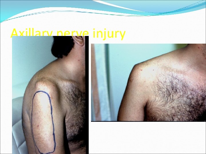 Axillary nerve injury 