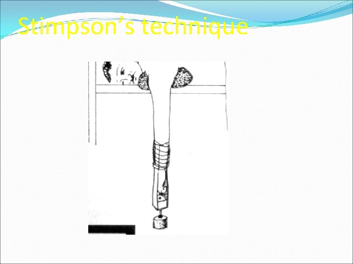 Stimpson’s technique 