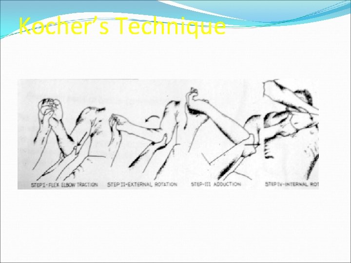 Kocher’s Technique 