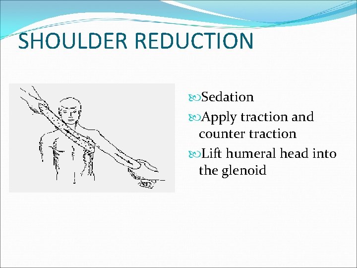 SHOULDER REDUCTION Sedation Apply traction and counter traction Lift humeral head into the glenoid