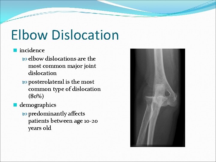Elbow Dislocation n incidence elbow dislocations are the most common major joint dislocation posterolateral