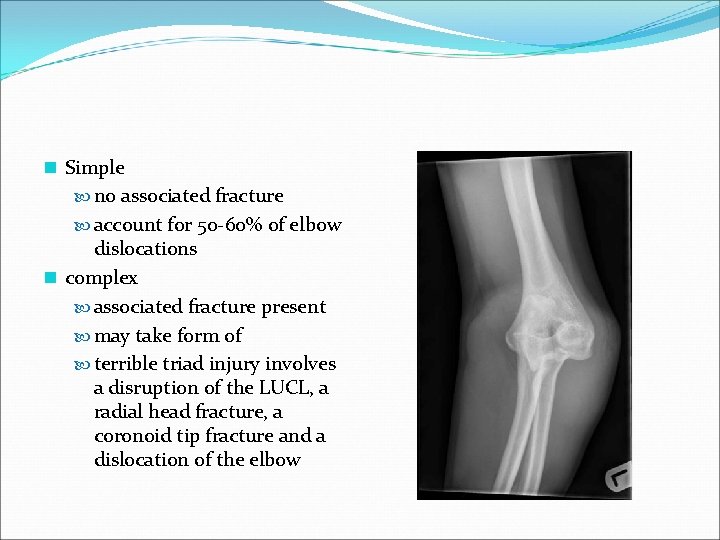 n Simple no associated fracture account for 50 -60% of elbow dislocations n complex