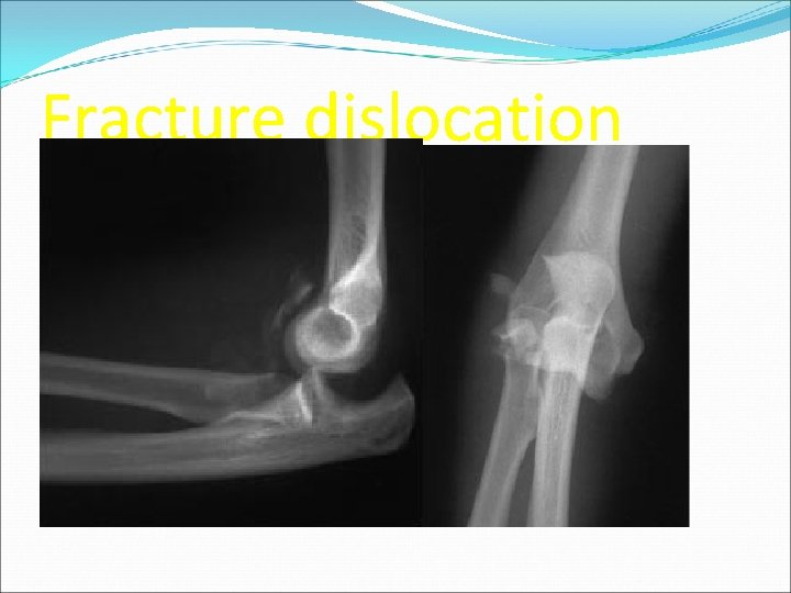 Fracture dislocation 