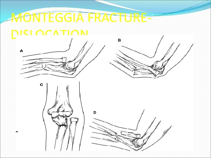 MONTEGGIA FRACTUREDISLOCATION 